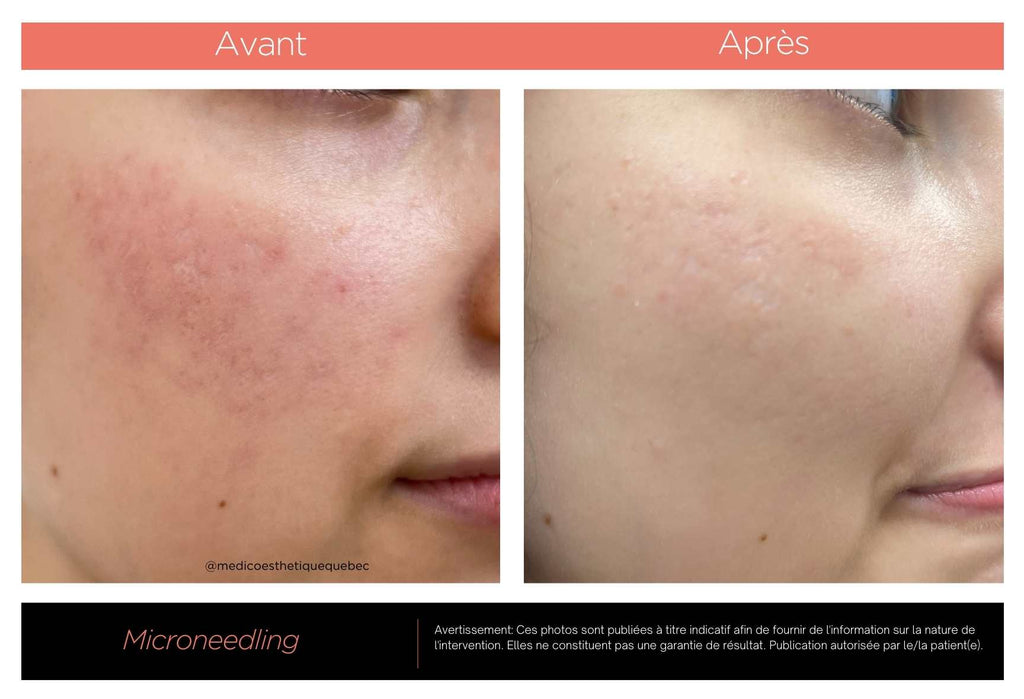 Microneedling avant/après: Cicatrice d'acné