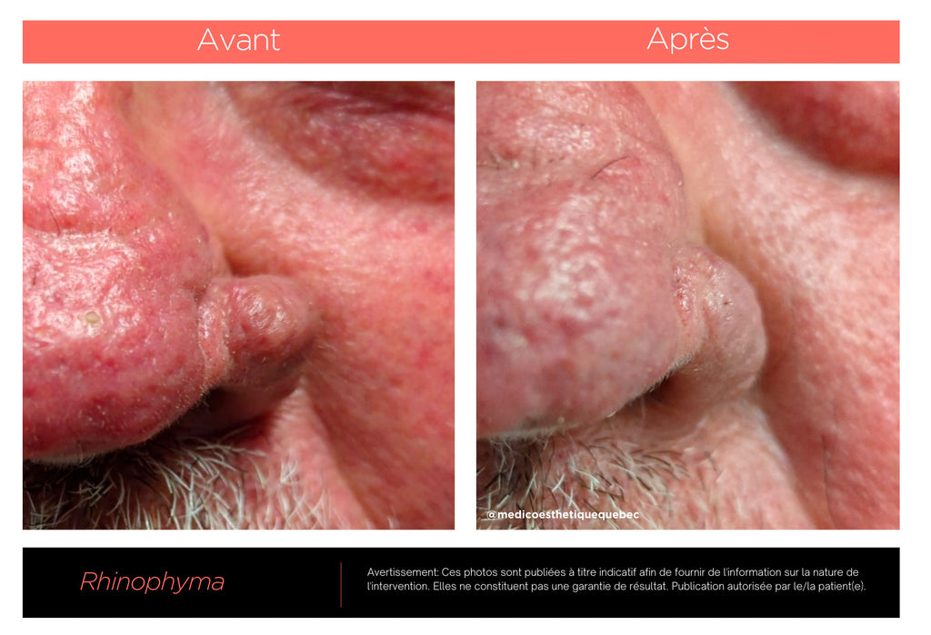 Rhinophyma: Rosacée sur le nez