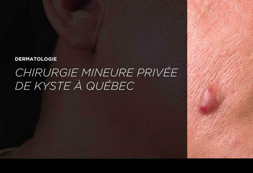 Chirurgie Mineure Kyste Qu bec Clinique Priv e Clinique M dico Chirurgie Mineure Kyste Qu bec Clinique Priv e Clinique M dico