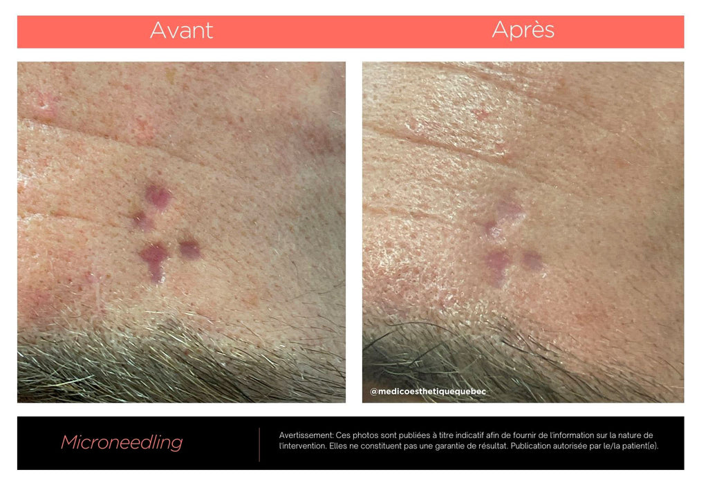 Dp4 Microneedling: Avant/Après cicatrice