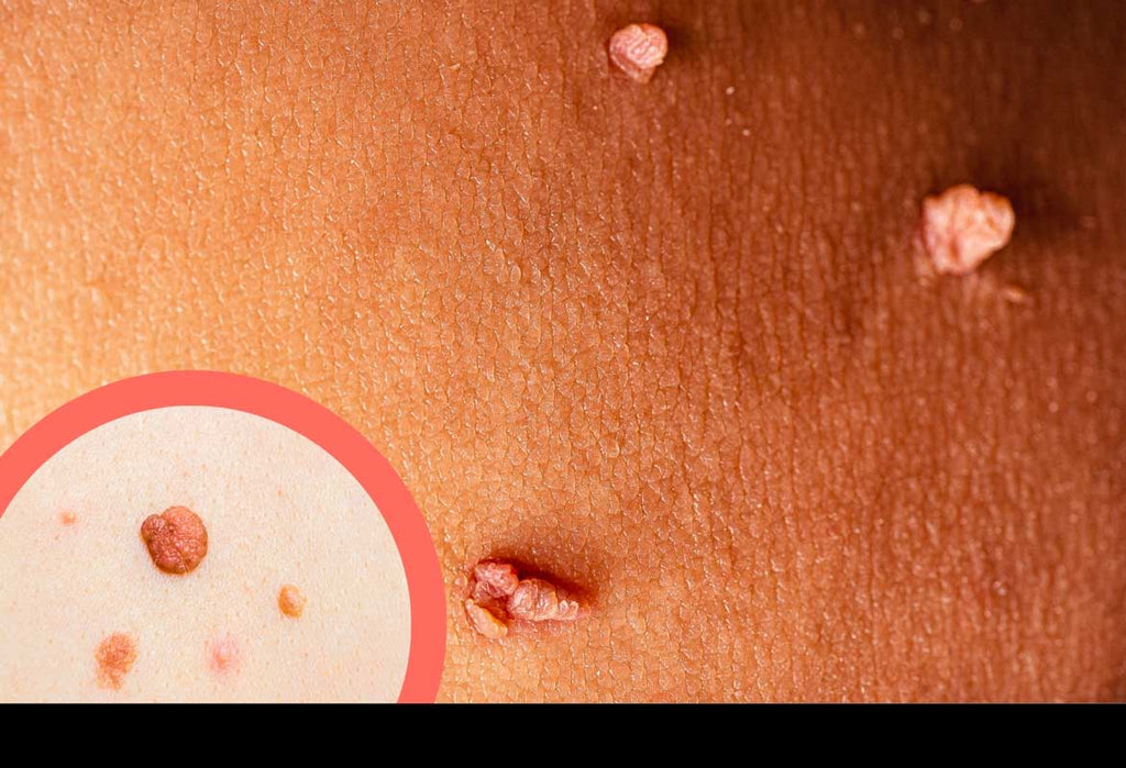 Excroissance peau : causes et traitements