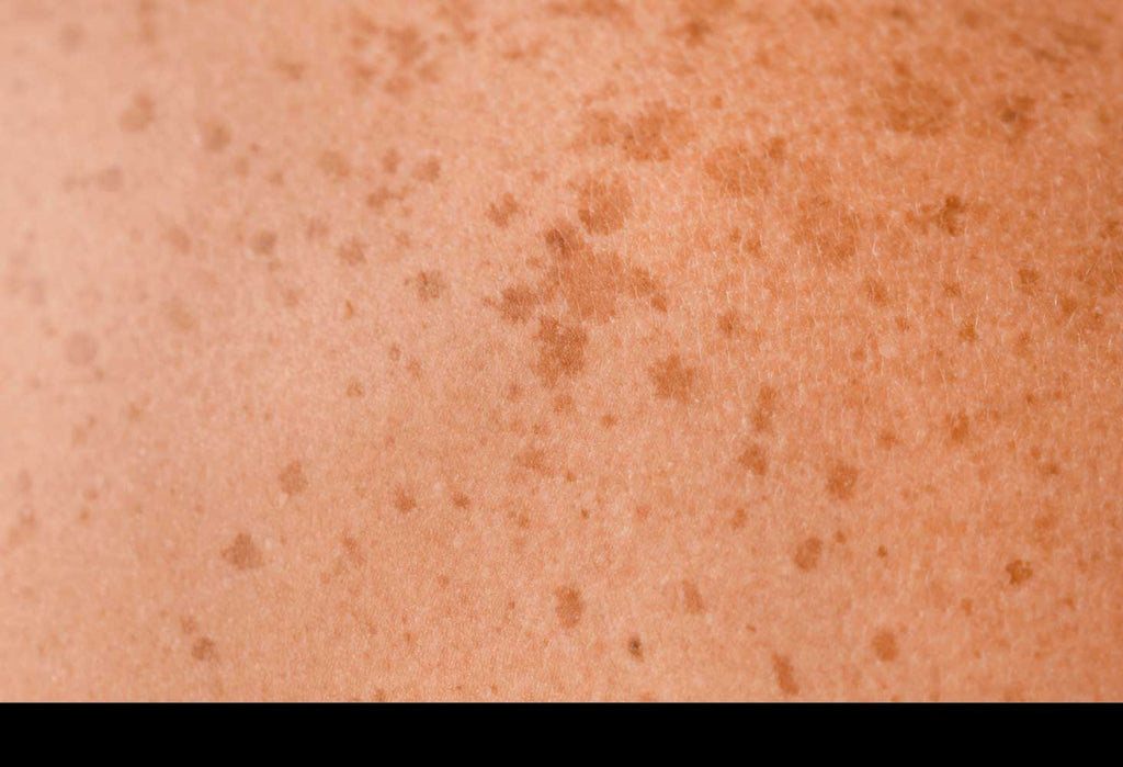 Tache peau brune : C'est quoi?