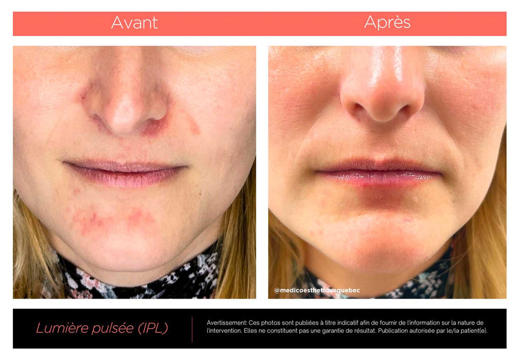 Traitement IPL avant/après du visage